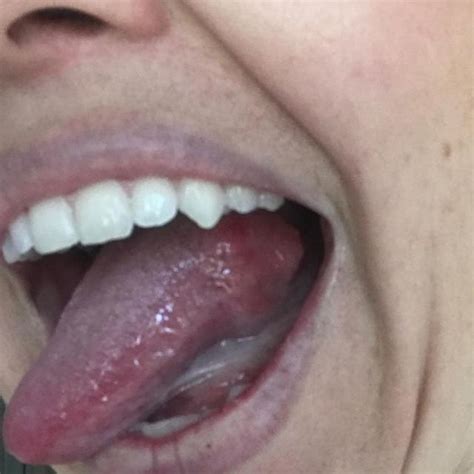 Sinister Twist After Mum 37 Finds Lump On Her Tongue