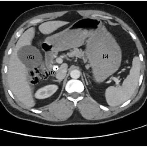 Abdominal Computed Tomography Ct Scan Reveals The Presence Of A 18