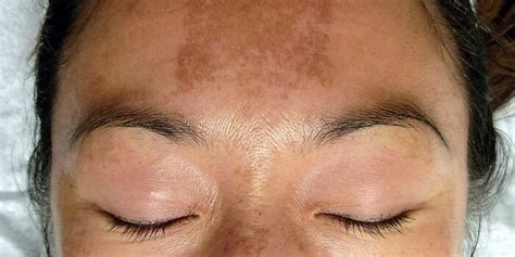 Why Is My Skin Turning Black 4 Causes Skin Care Geeks