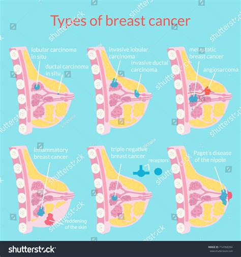 Types Breast Cancer Medical Poster Vector Vetor Stock Livre De