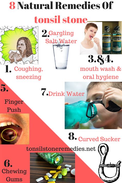 8 Natural Remedies To Treat Tonsil Stones