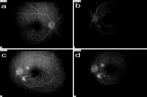 Fluorescein Angiography Of The Patients Right Eye Showing Localized