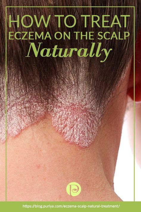 How To Treat Eczema On Scalp Naturally Artofit