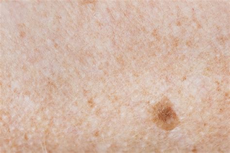 Melanoma And Age Spots Age Spots Maryland The Vein Center