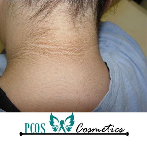 Acanthosis Nigricans And How To Get Rid Of Dark Spots Pcos Worldwide