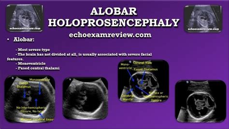 Alobar Holoprosencephaly Diagnostic Medical Sonography Ultrasound