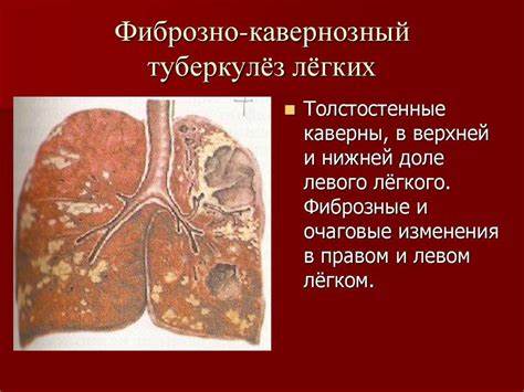 Диета при фиброзе 1 Диета При Фиброзе Легких — Похудение Диета Правильное Питание Диета При Фиброзе Легких — Похудение Диета Правильное Питание Диета при фиброзе 1
