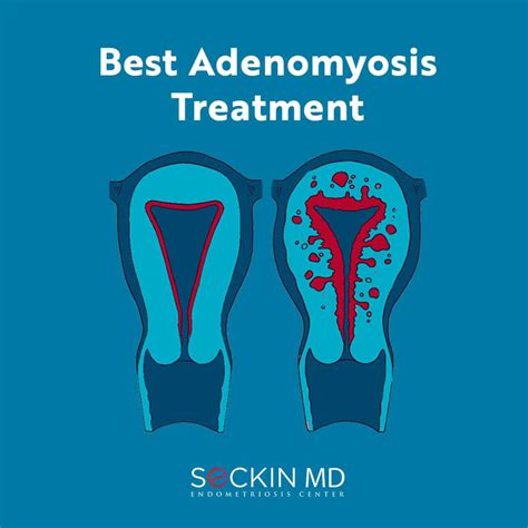 Best Adenomyosis Treatment Seckin Endometriosis Center