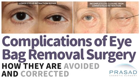 Eye Bag Removal Surgery Procedure Risks Recovery