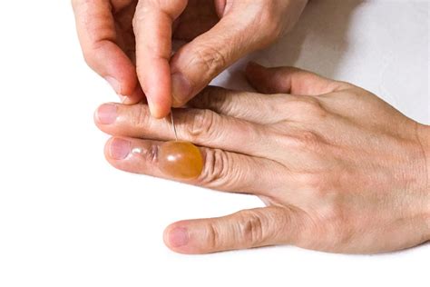 How To Care For A Blister Avoiding Infection