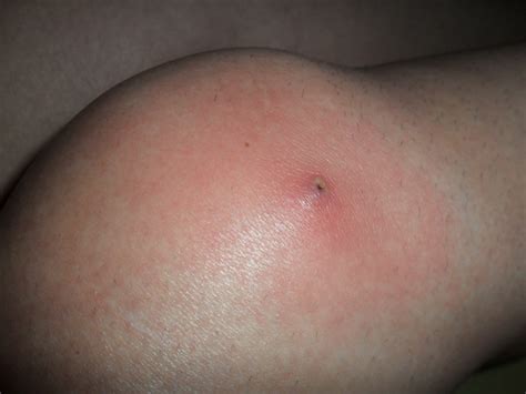 Un jour vous êtes ravie parce que votre peau frôle de très près la perfection. Comment traiter un furoncle