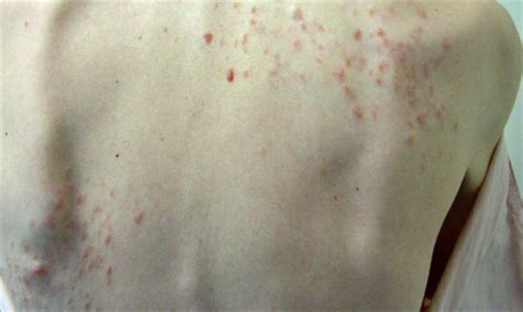 Skin Cancer Rash On Back