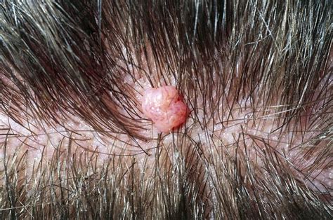 Close Up Of A Benign Mole On Scalp Of Young Man Stock Image M220