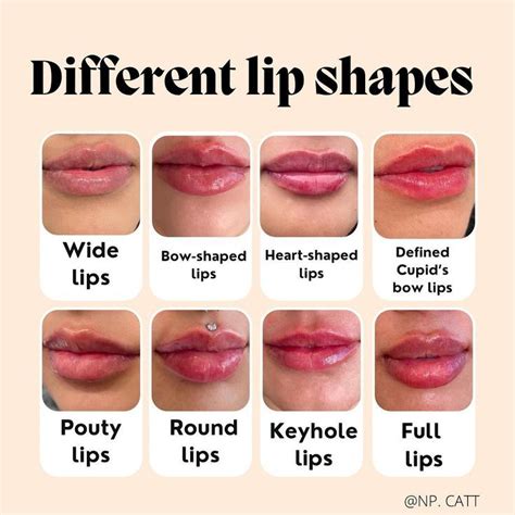 Different Lip Filler Shapes In 2022 Lip Fillers Lip Shapes Lips
