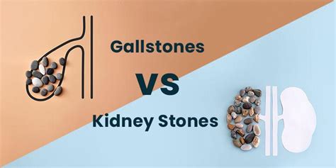 Gallstones Vs Kidney Stones Differences And Similarities