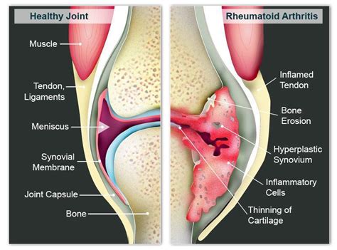 Rheumatoid arthritis affects more than 2 million americans, mostly women. Osteo and Rheumatoid Arthritis: Causes, Prevention, and ...