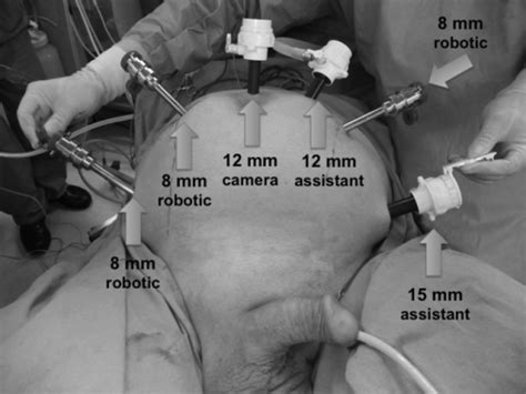 Trocar Placement Sites For Robot Assisted Radical Cyste Open I