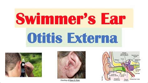 Swimmers Ear Otitis Externa Risk Factors Causes Signs And Symptoms