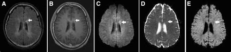 A Type Ib Lesion In A Patient With Ms A Axial T2 Flair Brain Mri