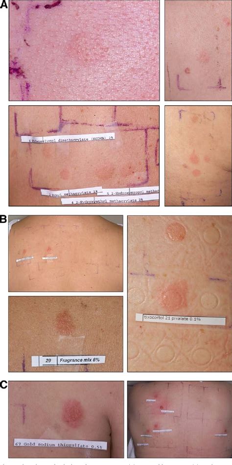 Figure 4 From Basics Of Patch Testing For Allergic Contact Dermatitis