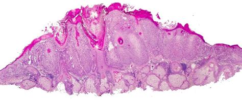 Seborrheic Keratosis With In Situ Squamous Cell Carcinoma Changes