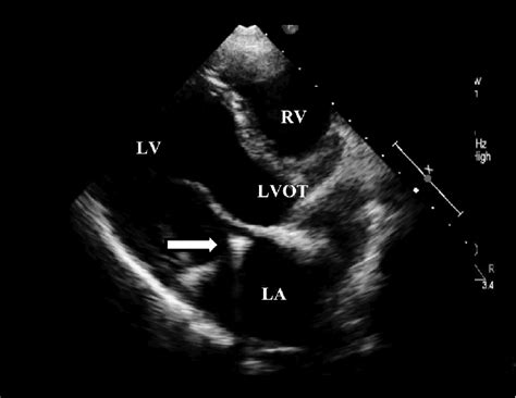 Parasternal Long Axis View Of The Echocardiogram Showing Gross