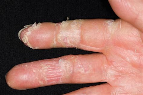 Exfoliative Dermatitis On The Hand Photograph By Dr P Marazziscience