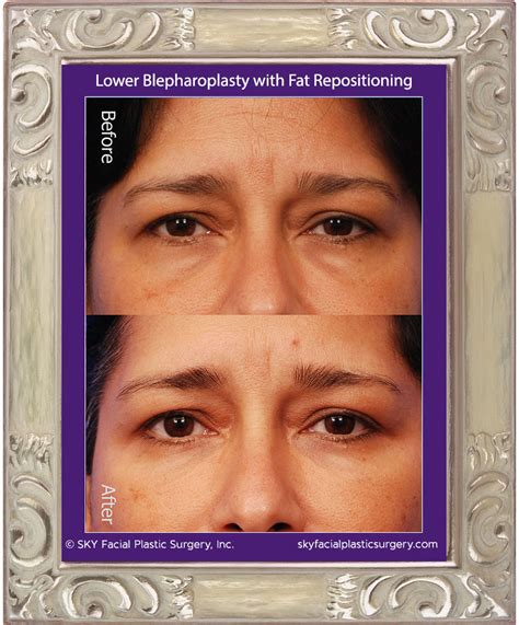 Blepharoplasty Eyelid Lift Surgery San Diego — Sky Facial Plastic