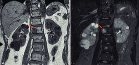 Magnetic Resonance Imaging T1 Weighted A And Fat Suppressed