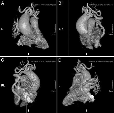 3d Reconstruction By Computed Tomography Volume Rendering Of The Heart