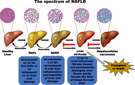 Spectrum Of Nafld Progression The Development Of Nafld Is Divided Into