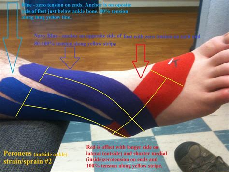 Lateral Ankle Peroneus Longus Kt Tape Perfect For My Peroneal Tendon