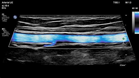 Vascular Ultrasound System Portfolio Philips