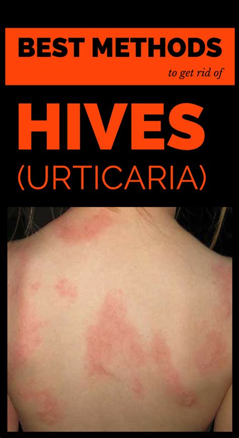 Hives Also Known As Urticaria Is A Dermatological Affection