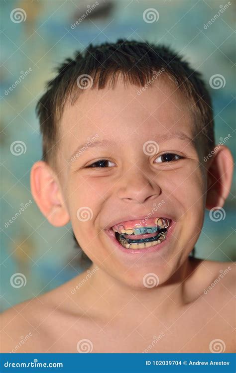 A Child With Braces Smiles Stock Photo Image Of People 102039704
