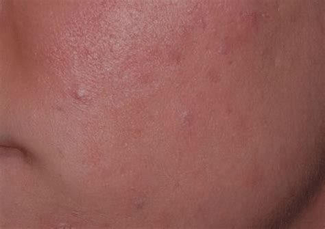 Pre Cancerous Cells And Acne Bacteria Arlington Skin Doctor