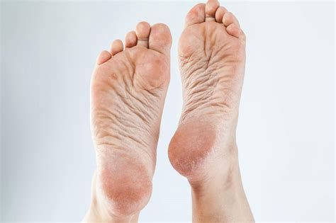 Understanding Dry Feet Causes And Solutions Guide