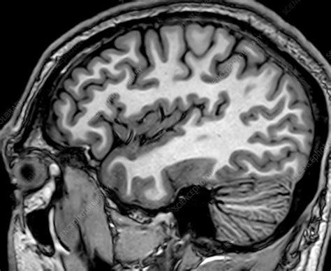 Normal Sagittal T1 Mri Brain 3 Stock Image C0393733 Science