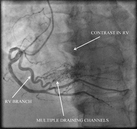 ‘a Rare Cause Of Angina Multiple Coronary Cameral Fistulae Simulating