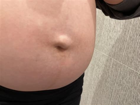 Belly Button Hernia Babycenter