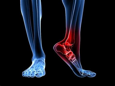Charcot Marie Tooth Disease How It Affects The Foot And Ankle Phoenix