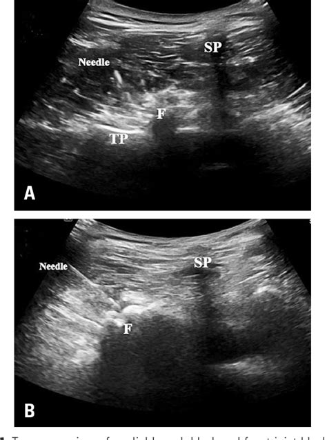 Ultrasonography Of The Adult Thoracic And Lumbar Spine For Central Images
