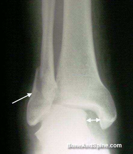 X Rays Of Ankle Fractures Bone And Spine
