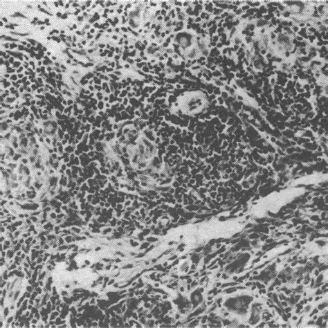 Photomicrograph Of Section Of Subcutaneous Malignant Melanoma