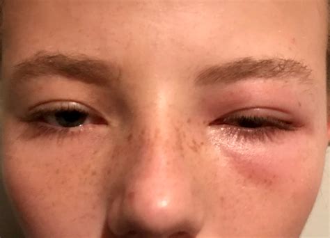 14 Year Old ‘blinded By 3 Kmart Eye Mask New Idea Magazine