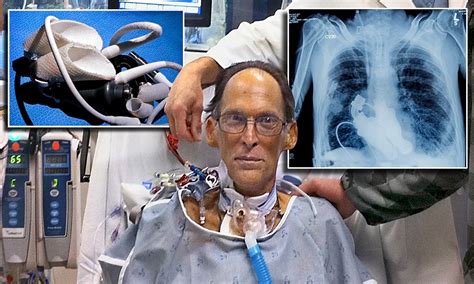 Meet The First Heartless Man Who Is Able To Live Without A Heartbeat Or
