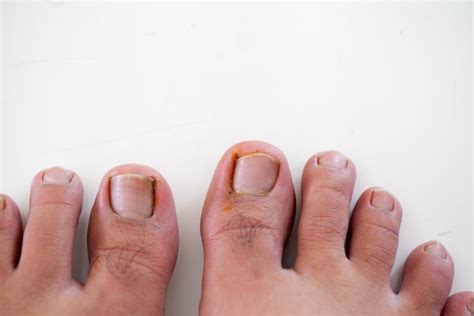 Ten Common Foot Problems Causes And Treatment