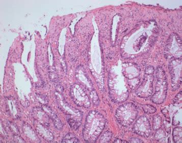 Histopathology Images Of Polyp Hyperplastic Colon By