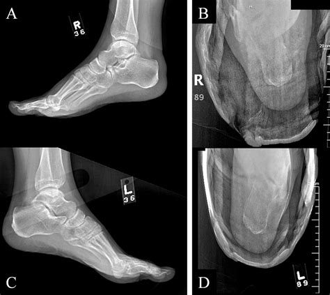 Bilateral Isolated Fractures Of The Sustentaculum Tali A Ca Jbjs