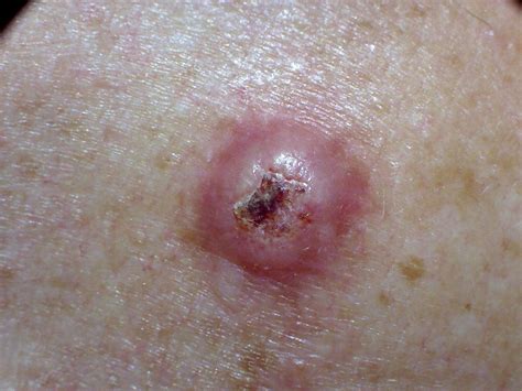 Squamous Cell Carcinoma Symptoms Causes Treatment And More